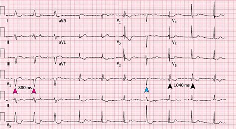 abnormal ekg results examples